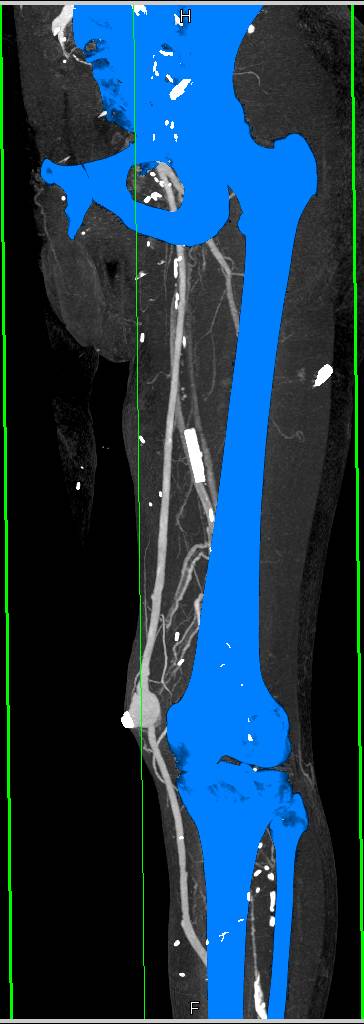Pseudoaneurysm at Level of Knee - CTisus CT Scan