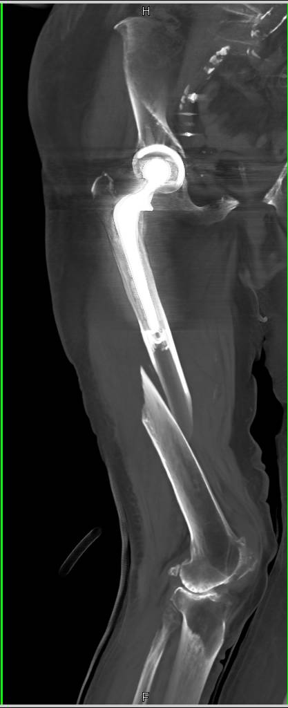 spiral-femur-fracture-occurs-just-below-stem-of-total-hip-replacement