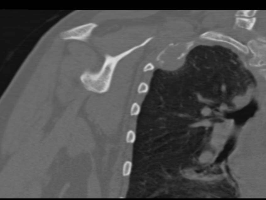 Renal Cell Carcinoma Metastatic to Ribs - CTisus CT Scan