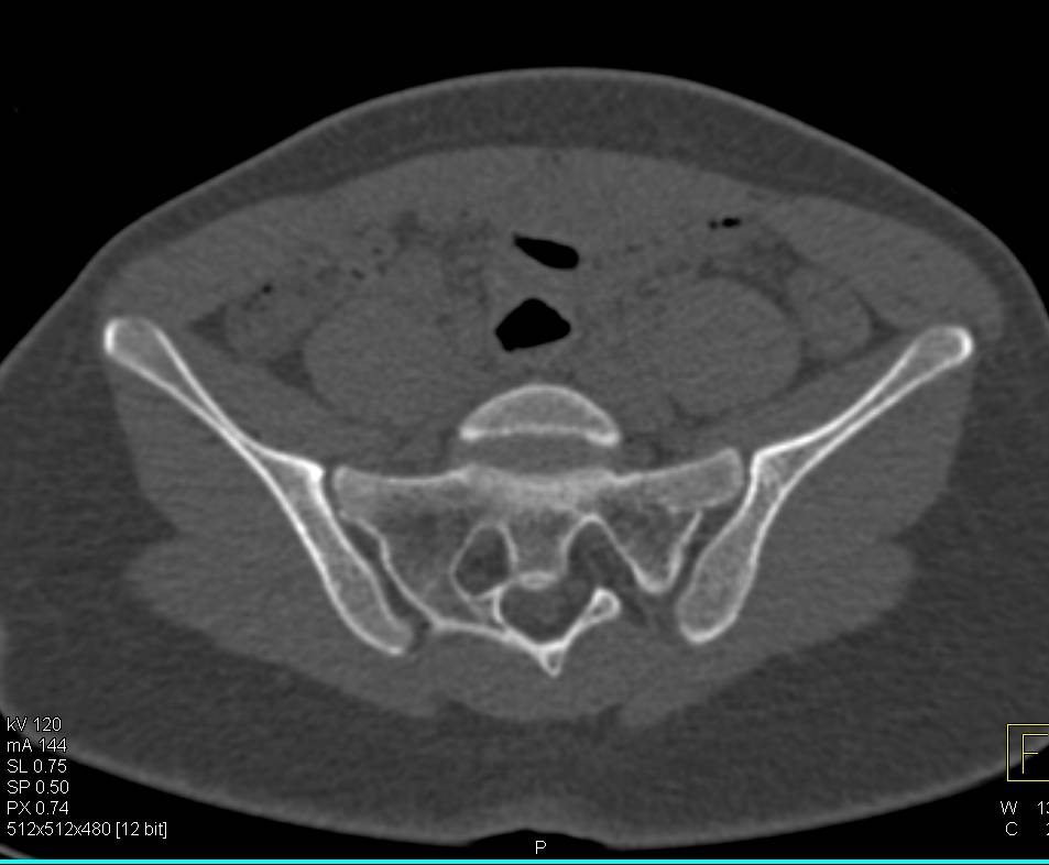 Subtle Fracture Through a Bone Cyst in the Acetabulum - CTisus CT Scan