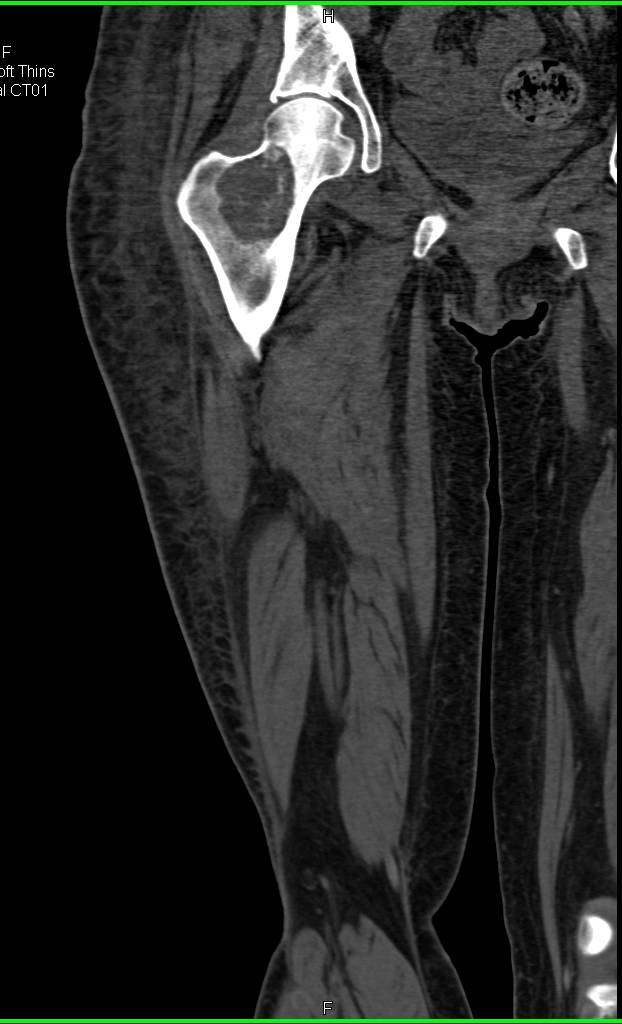 Cystic Lesion Femur was Fibrous Dysplasia - CTisus CT Scan