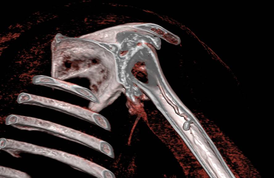 CT Arthrogam with Severe Degenerative Joint Disease (DJD) Shoulder - CTisus CT Scan