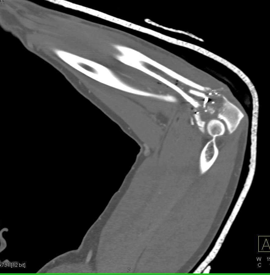 Comminuted Ulna Fracture without Vascular Injury - CTisus CT Scan