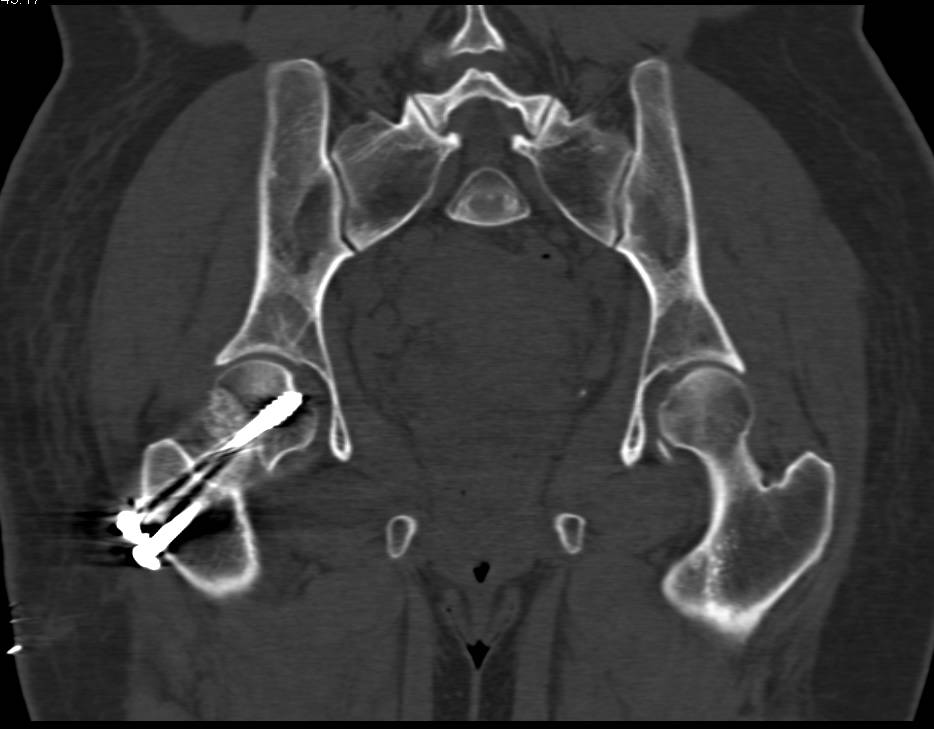 Pins Placed for SCFE (Slipped Capital Femoral Epiphysis) - CTisus CT Scan