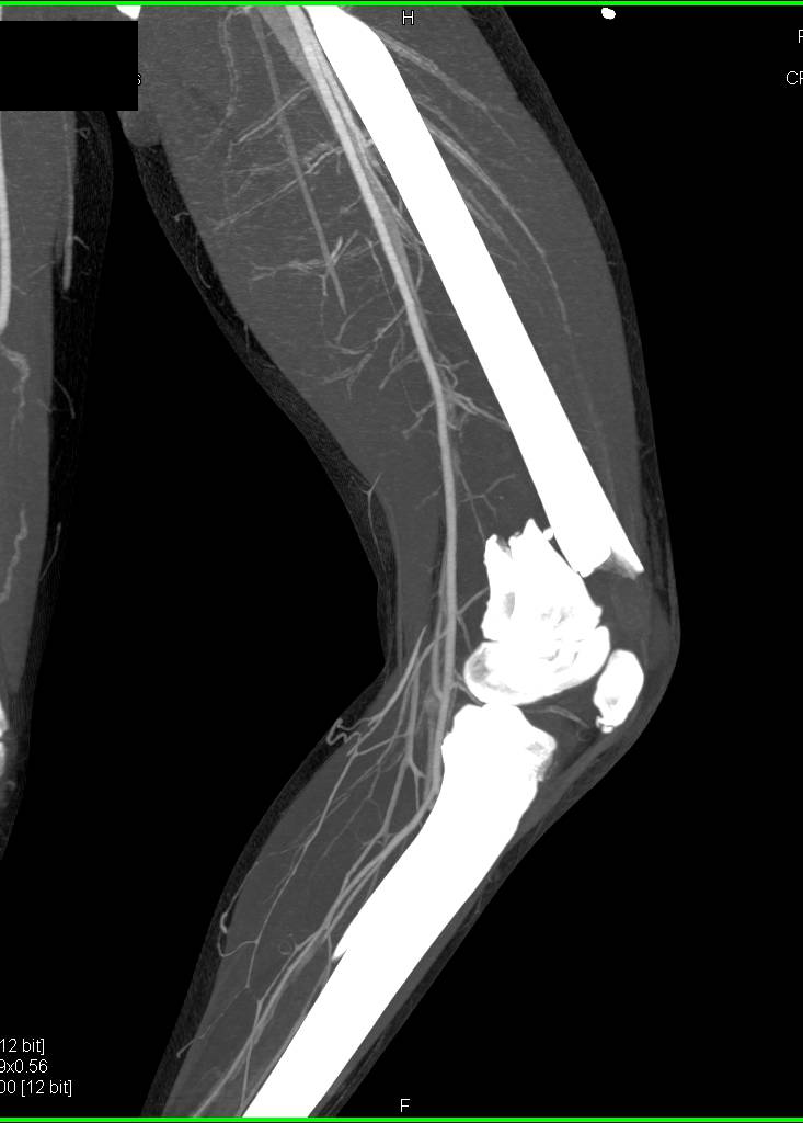 Comminuted Distal Femur Fracture Without Vascular Injury on CTA - CTisus CT Scan