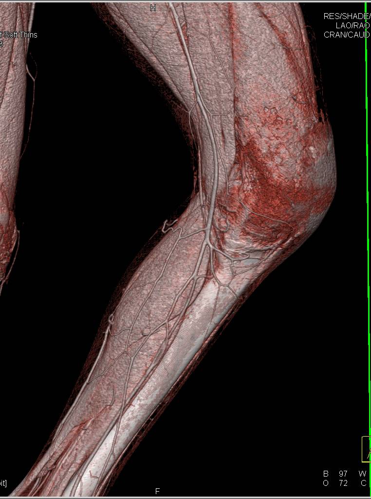 Comminuted Distal Femur Fracture Without Vascular Injury