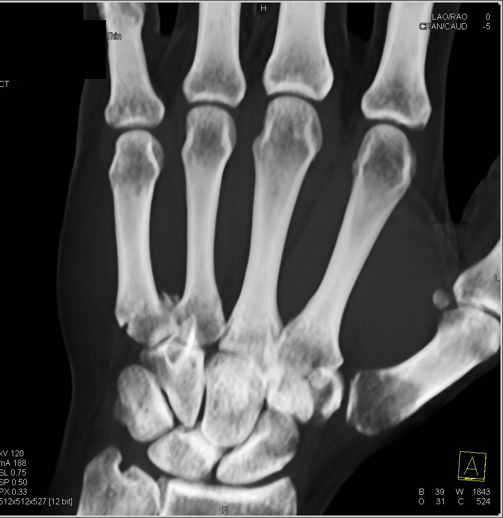 Fracture Base of 5th Metacarpal - Musculoskeletal Case Studies - CTisus