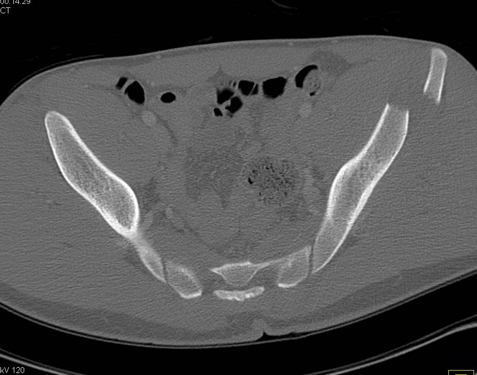 Complex Acetabular Fracture and Dislocation with Extension into the Iliac Wing - CTisus CT Scan