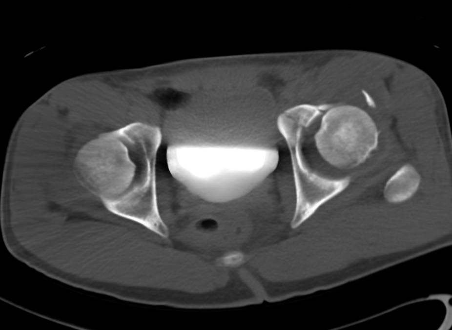 3D Mapping of Left Acetabular Fracture with Anterior Dislocation - CTisus CT Scan