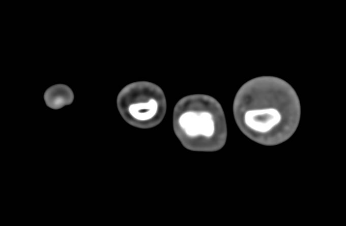 Cellulitis 2nd Digit in 3D - CTisus CT Scan