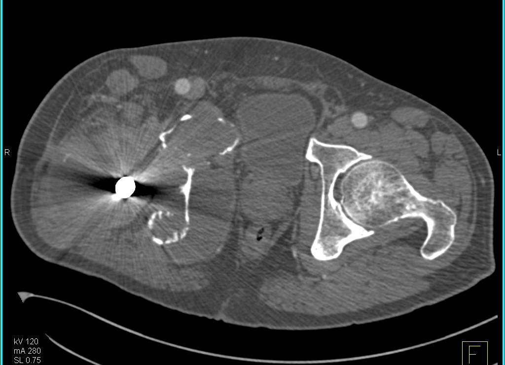 Metastatic Disease to Bone in Patient with a Total Hip Replacement - CTisus CT Scan