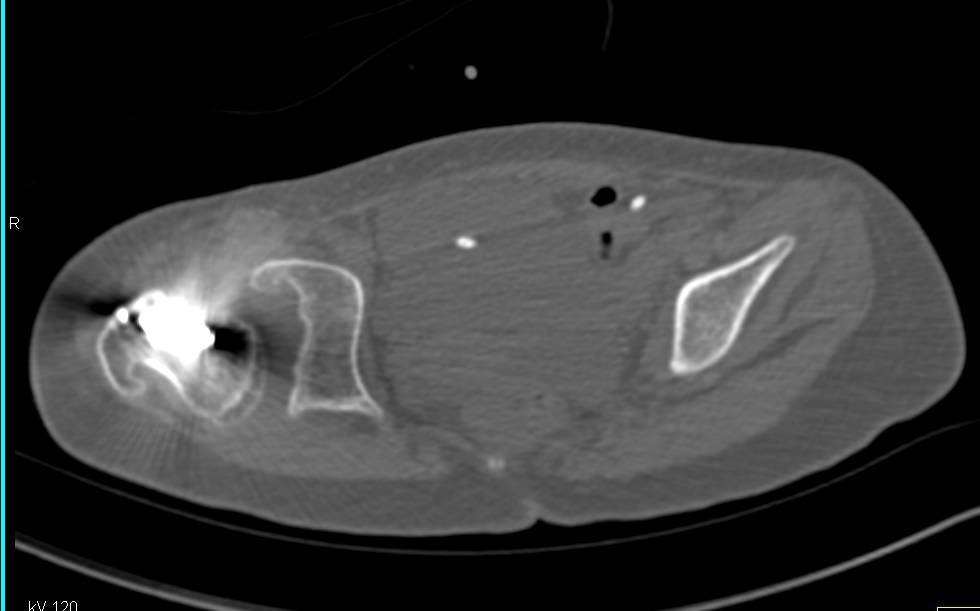 Dysplastic Right Hip with Deformed Acetabulum and Dislocated Hip - CTisus CT Scan