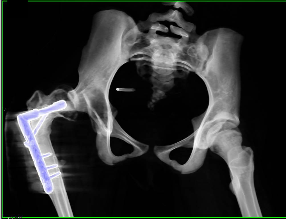 Hip Dysplasia with Shallow Acetabulum and Open Reduction Internal Fixation (ORIF) - CTisus CT Scan