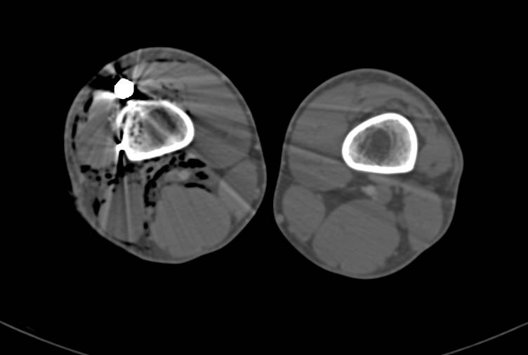 GSW Knee Without Vascular Injury - CTisus CT Scan