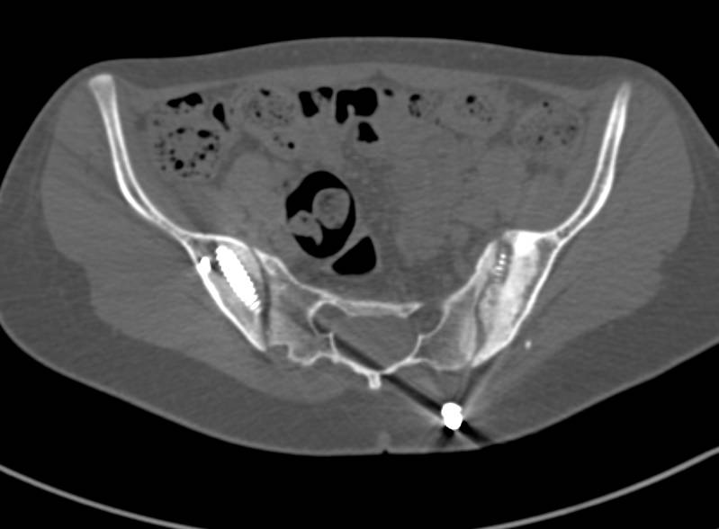 Broken Pin in Right Iliac Bone s/p Open Reduction Internal Fixation (ORIF) - CTisus CT Scan