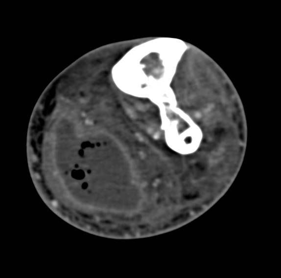 Extensive Abscess in the Calf - CTisus CT Scan