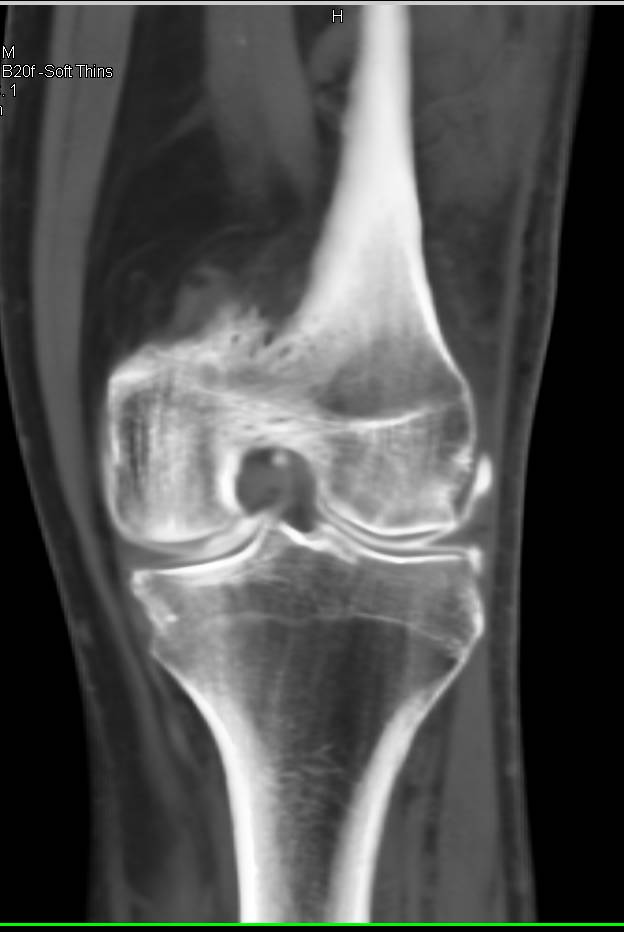 Meniscal Injury with Contrast in the Suprapatellar Bursa - CTisus CT Scan