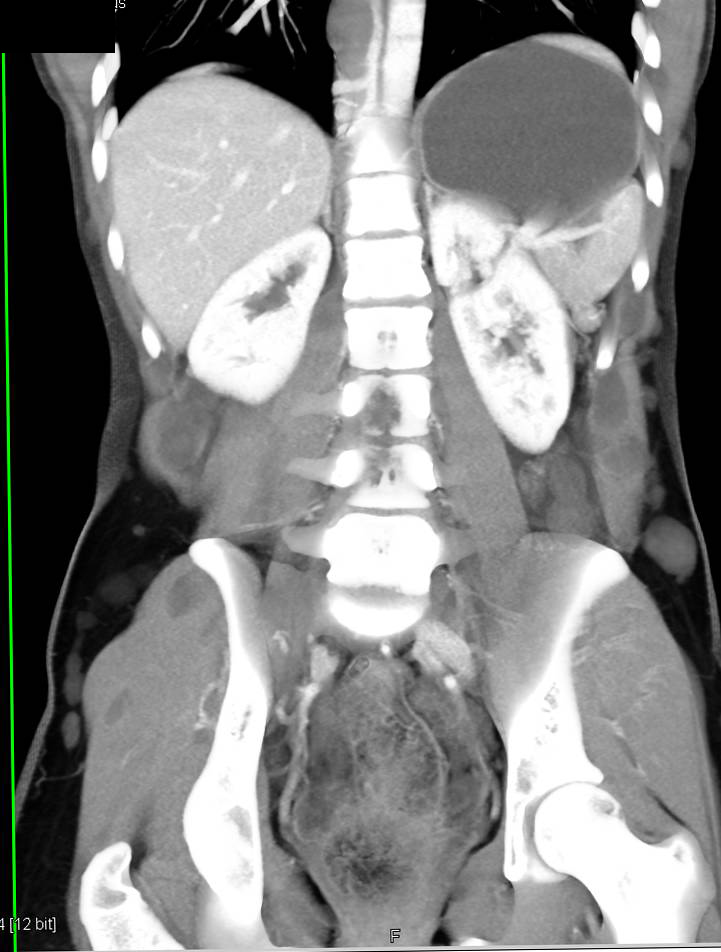 Incredible Example of Neurofibromatosis - CTisus CT Scan