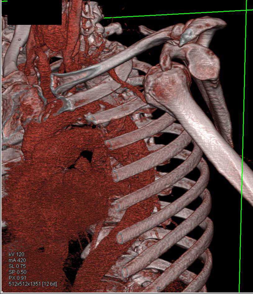 Beautiful Example of a Dislocated Left Shoulder - CTisus CT Scan