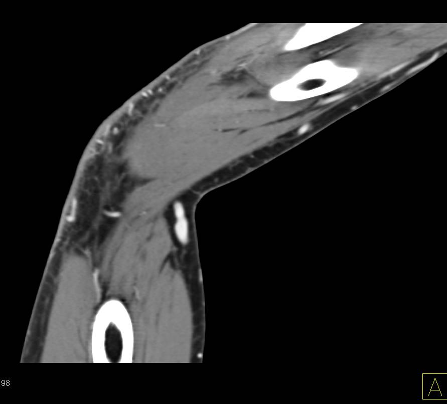 Osteomyelitis of the Humerus with Inflammation in Joint Space - CTisus CT Scan