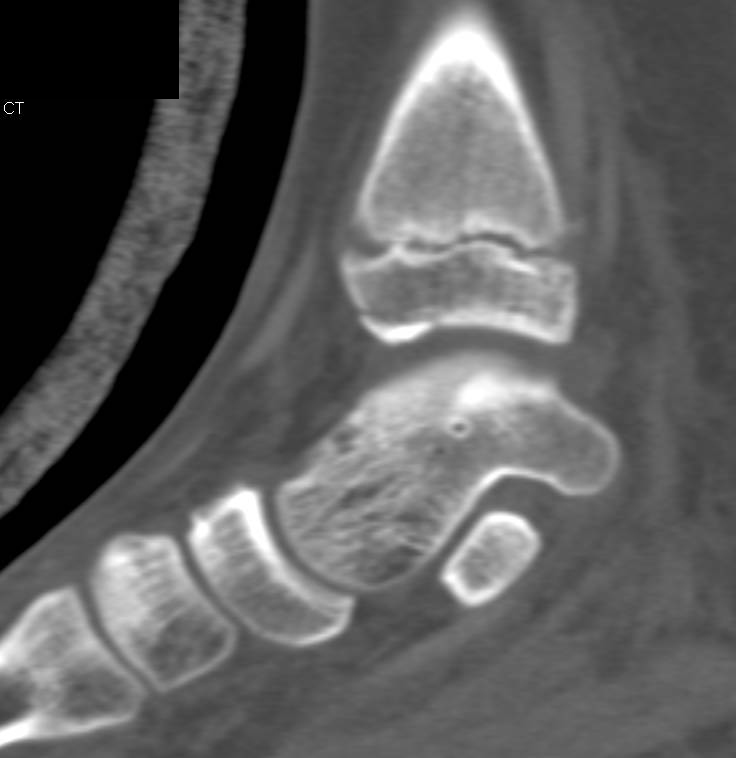 Fracture Through Epiphyseal Plate of Tibia - CTisus CT Scan