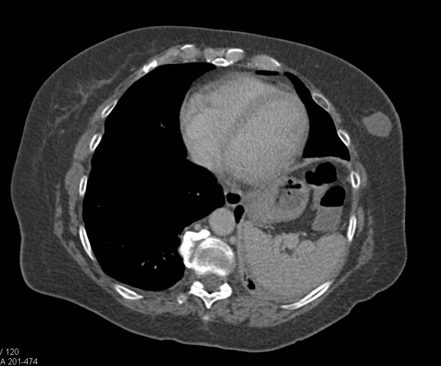 Lymphomatous Involvement of the Skin and Subcutaneous Tissues - CTisus CT Scan