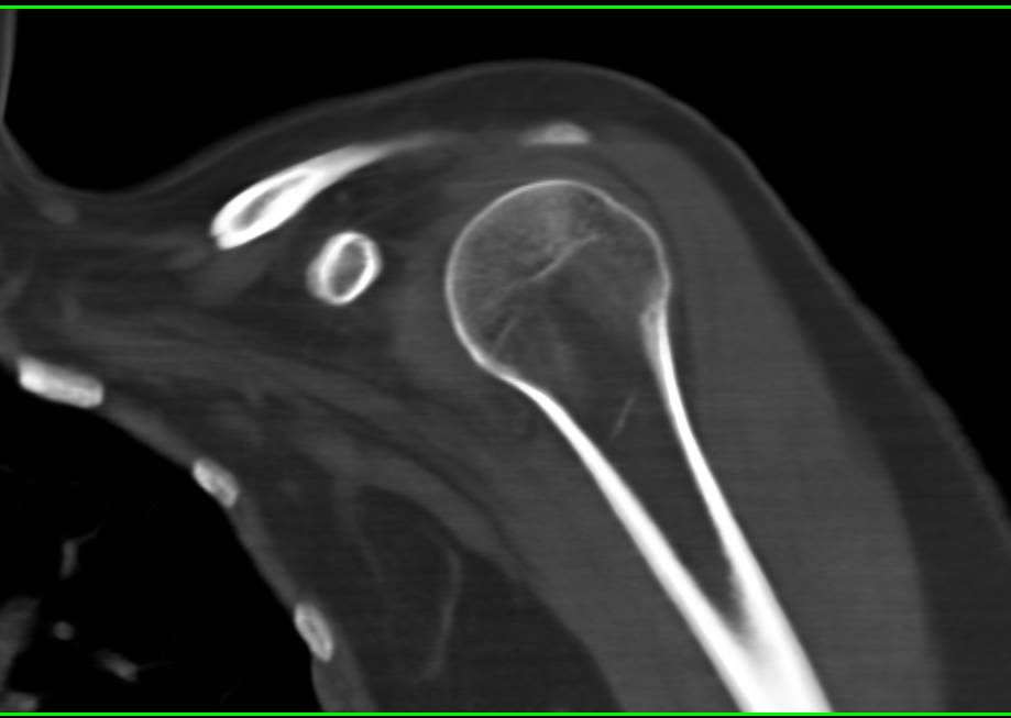 Subtle Osteoid Osteoma - CTisus CT Scan