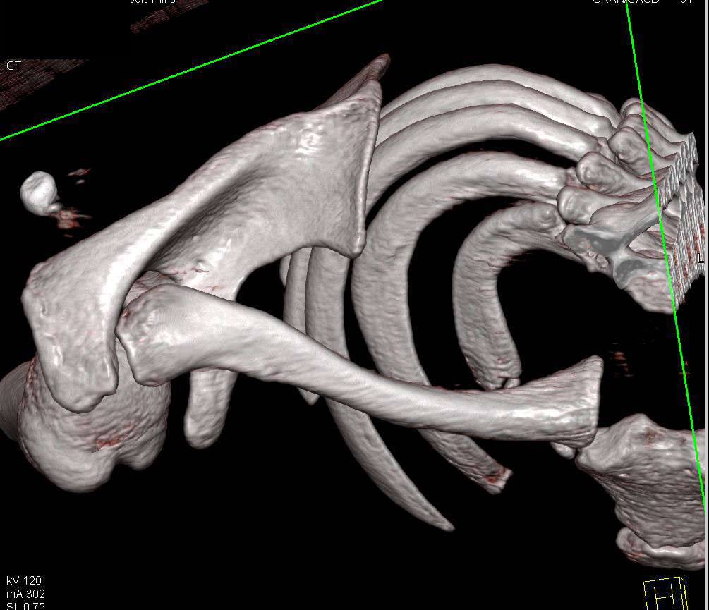 Posterior Dislocation of the Right Clavicle at Sternoclavicular Joint - CTisus CT Scan