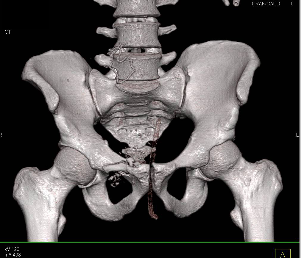 GSW with Superior Pubic Ramus Fracture and Bladder Injury - CTisus CT Scan