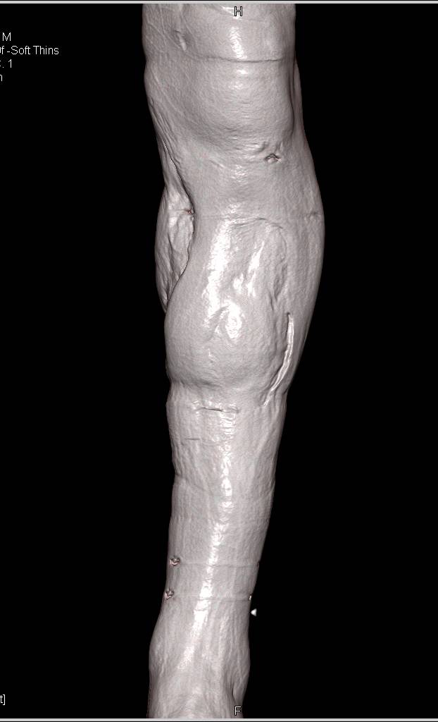 3D Rendering Following Skin Grafts for Tibia Fracture and Repair - CTisus CT Scan