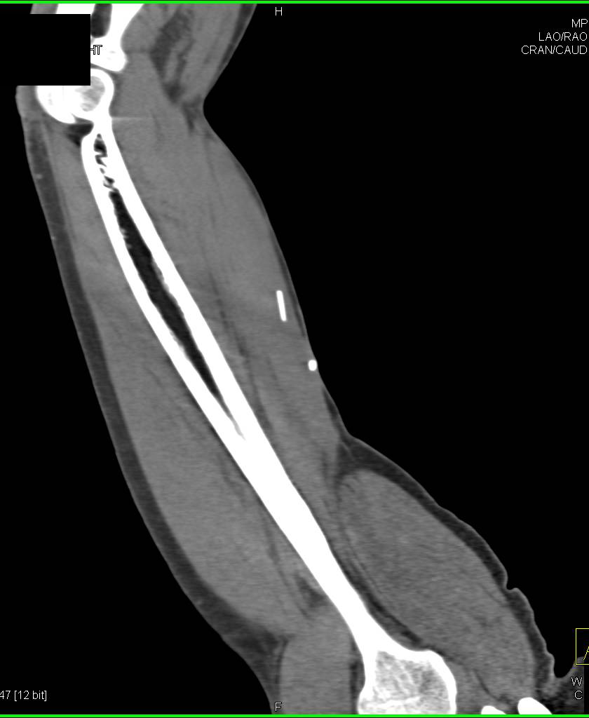 Needle is Broken in Forearm due to IV Drug Abuse - CTisus CT Scan