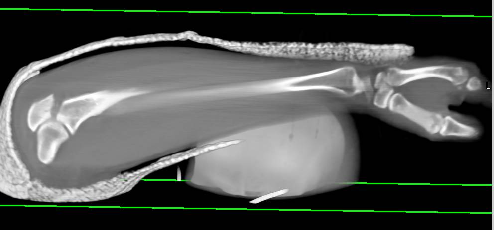 Ulnar Fracture - CTisus CT Scan
