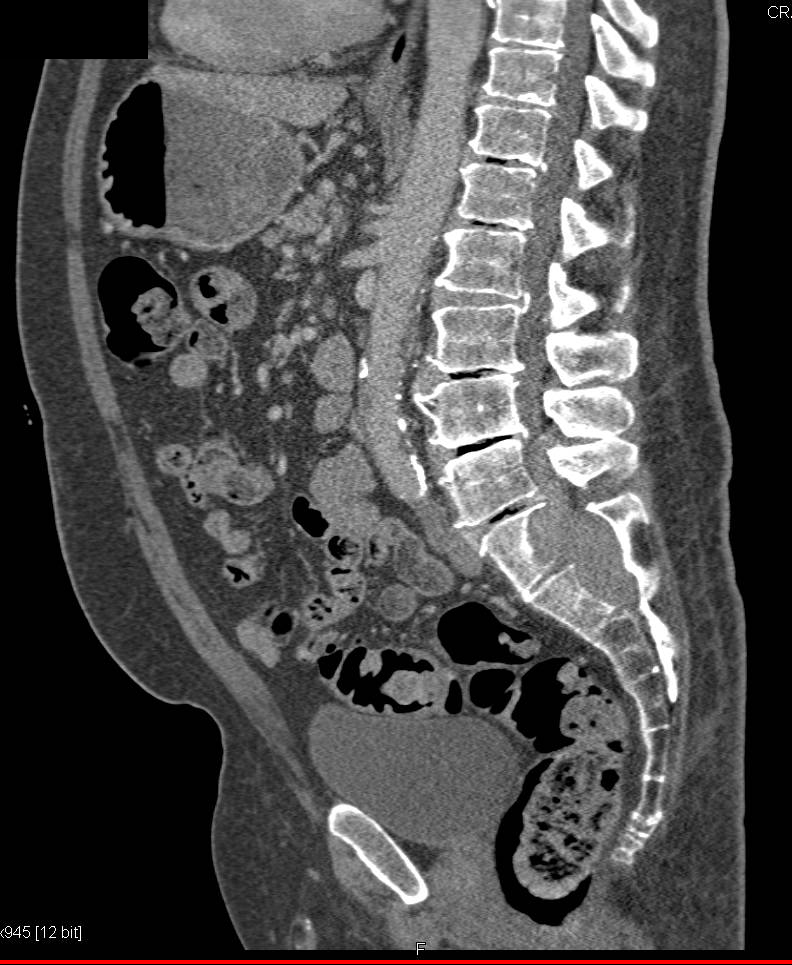 Tumor in Cord Erodes L5 Felt to be Neurogenic Tumor - CTisus CT Scan