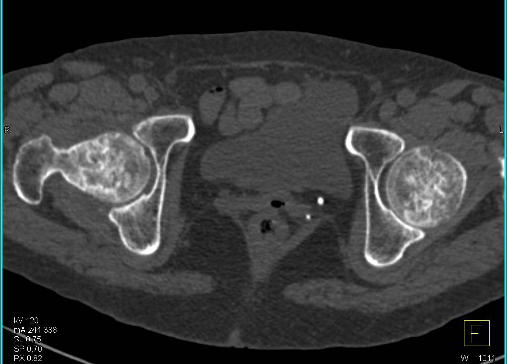 Bilateral Avascular Necrosis of the Femoral Heads - CTisus CT Scan