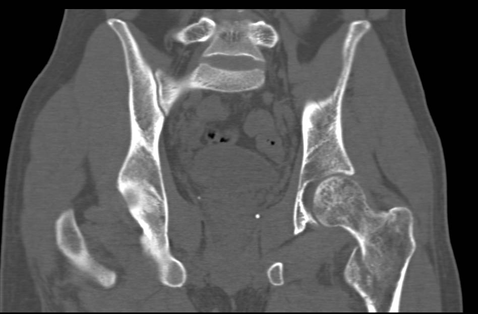 Fracture of Left Femur - CTisus CT Scan