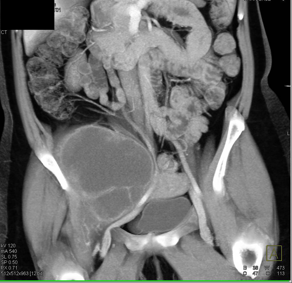 Sarcoma Involves Iliopsoas Muscle and Displaces Aorta and Right Iliac Artery - CTisus CT Scan