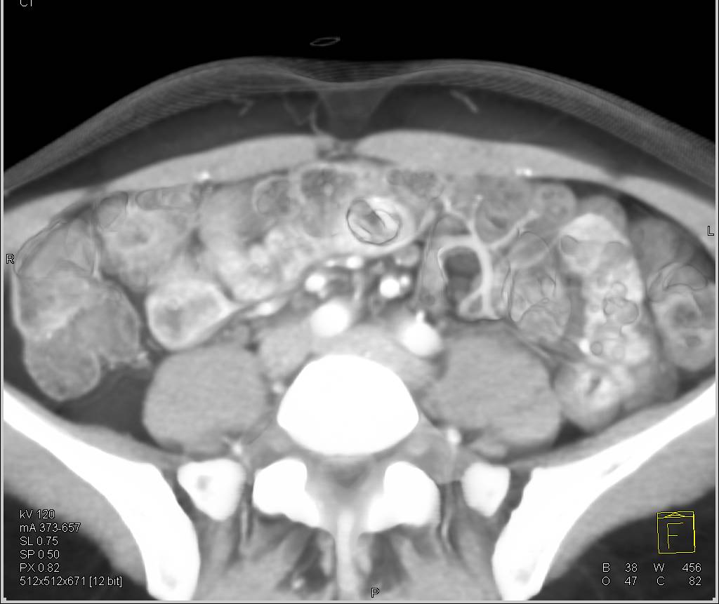 DIEP Flap Planning for Breast Reconstructive Surgery - CTisus CT Scan