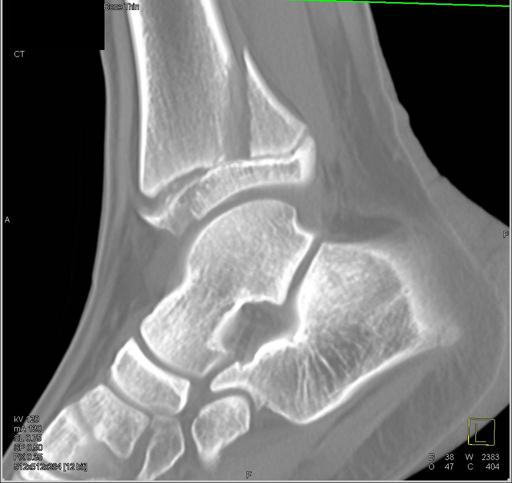 Fracture Through Epiphysis and into Joint Space with Injury to Epiphysis as Well - CTisus CT Scan