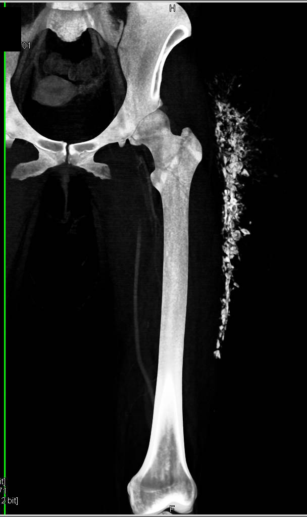 Heterotopic Ossification in Fasciae due to Prior Trauma - CTisus CT Scan