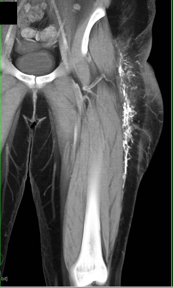 Ossification in Thigh Near Fasciae - CTisus CT Scan