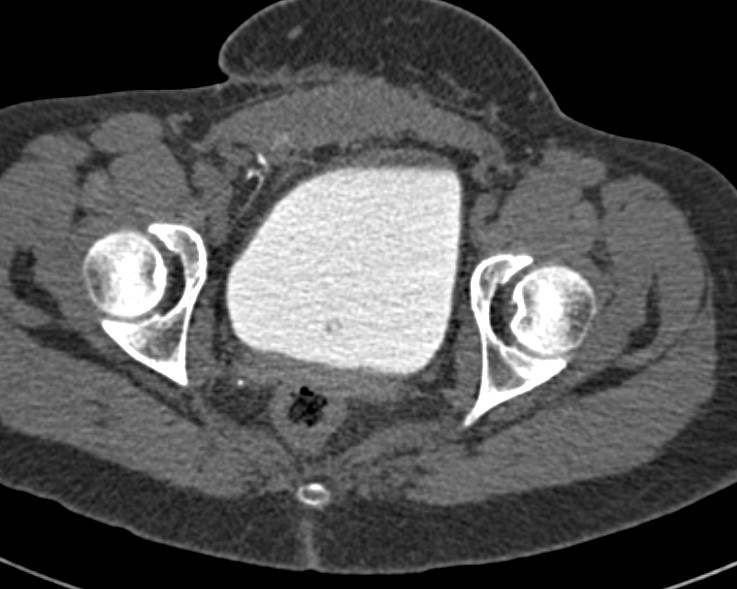 Retained Foreign Matter in the Right Pelvis - CTisus CT Scan