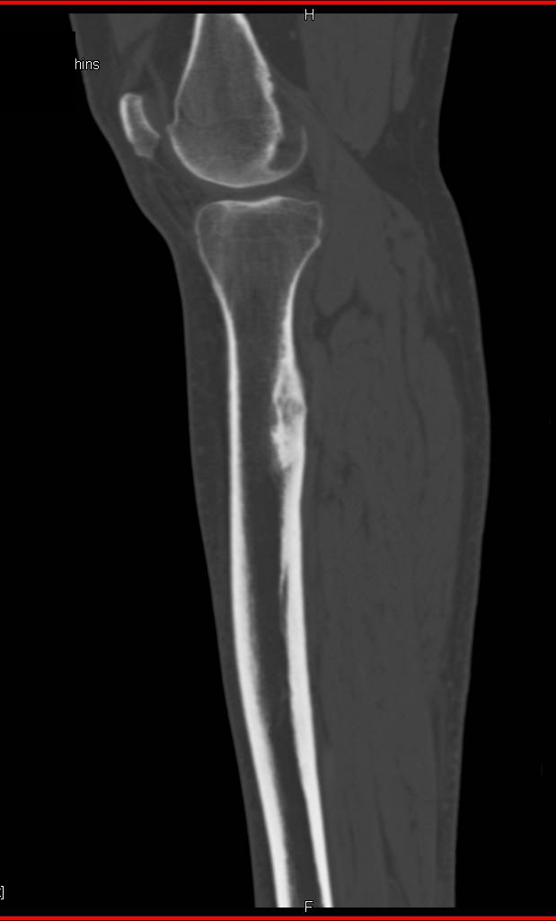 Chronic Infection Simulates an Osteoid Osteoma - CTisus CT Scan