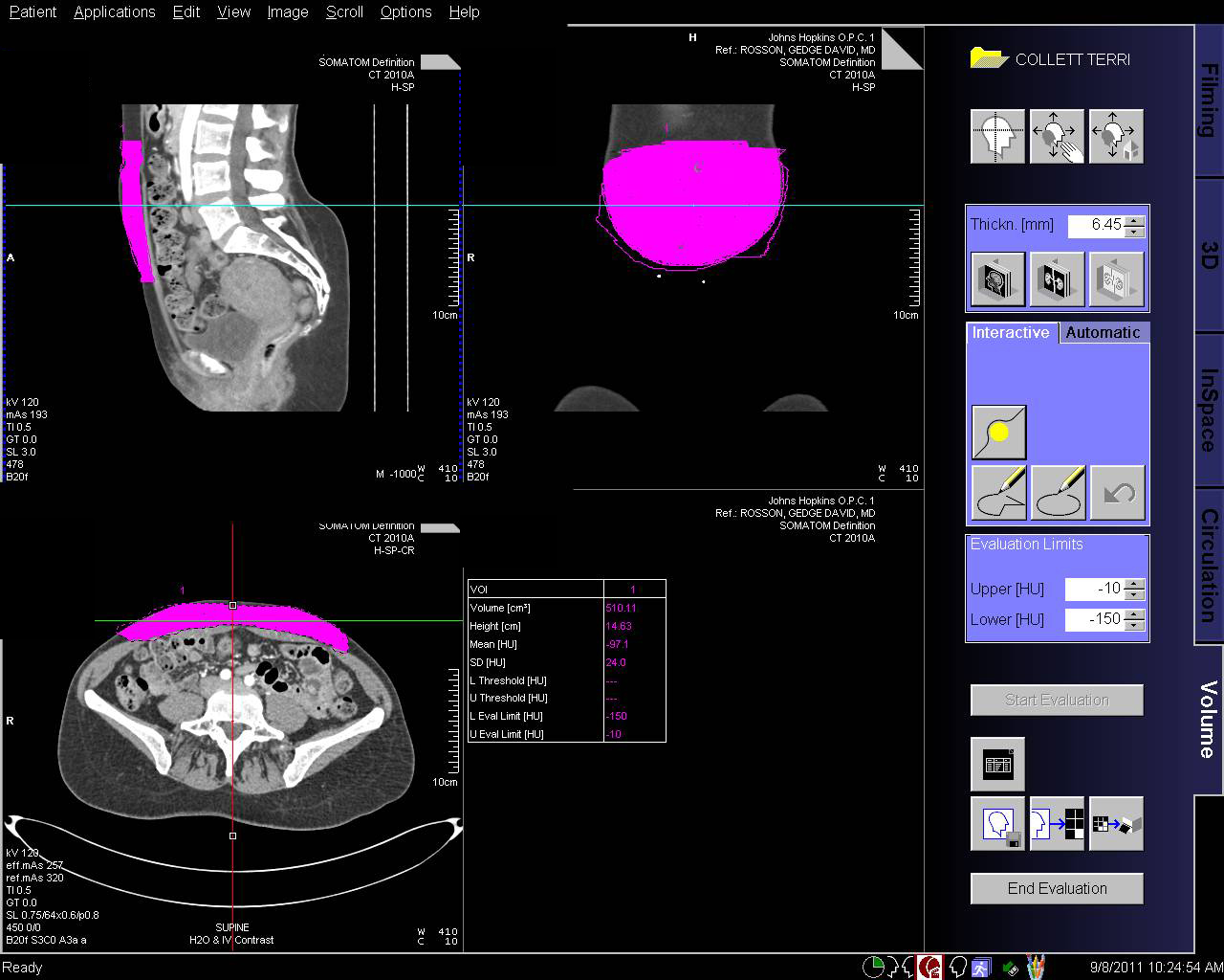 Calculating the Volume of a Flap for Breast Reconstruction - CTisus CT Scan