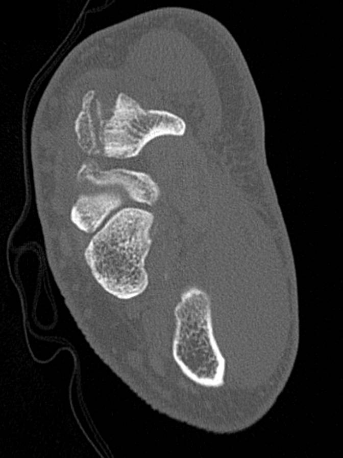 Multiple Carpal Bone Fractures Including Tibial Blood Flow - CTisus CT Scan