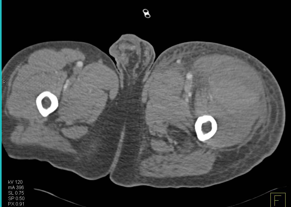 Left Thigh Hematoma - CTisus CT Scan