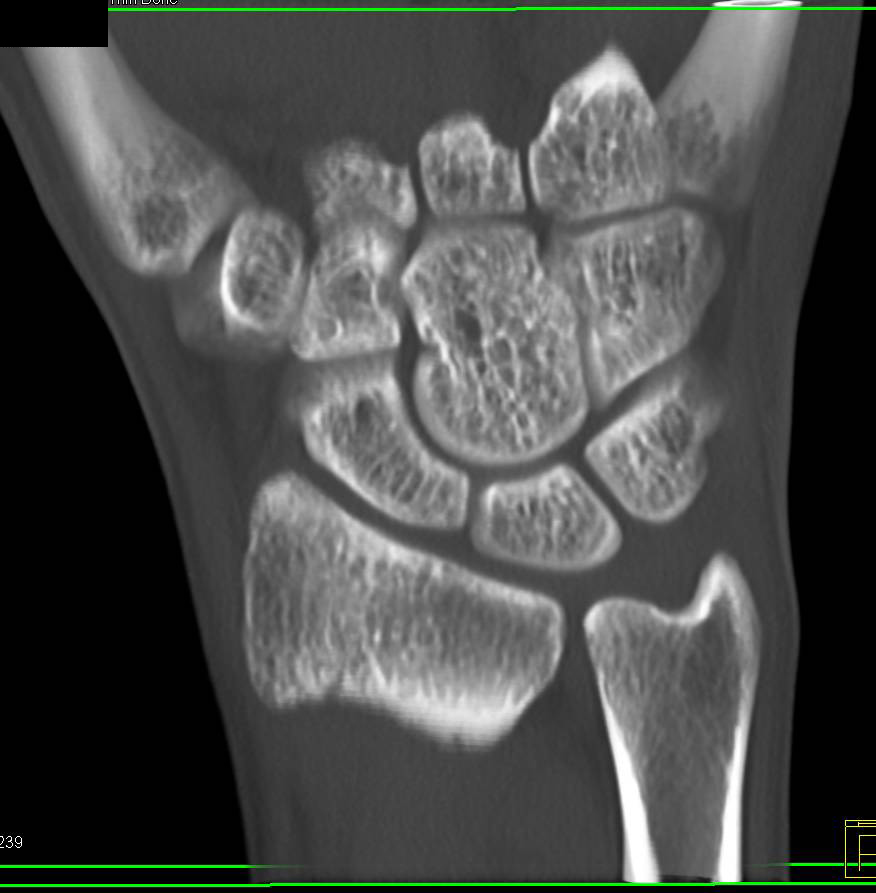 High Resolution Imaging of the Wrist - CTisus CT Scan