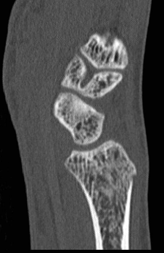 High Resolution Imaging of the Wrist - CTisus CT Scan