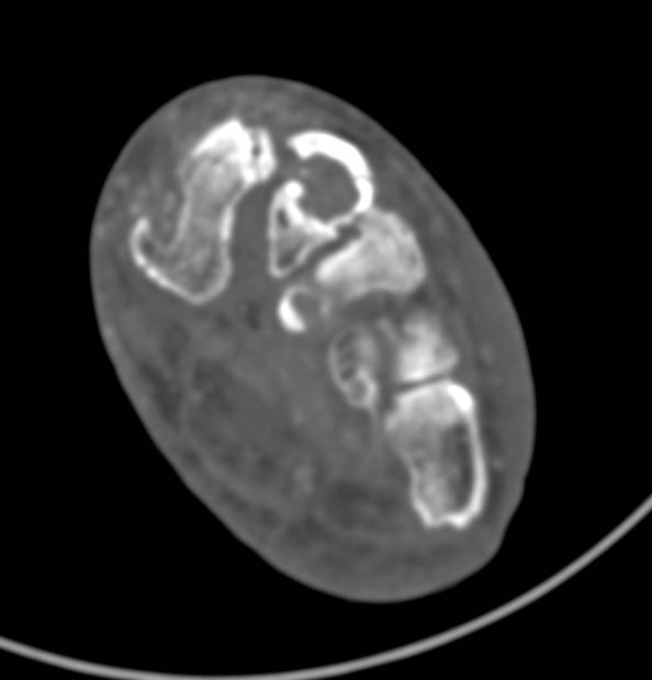 Gout in Foot with Punched out Lesions - CTisus CT Scan