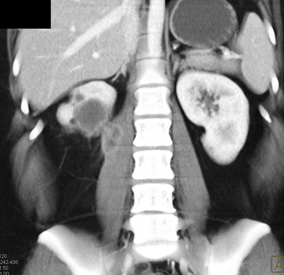 Renal Abscess Involves the Psoas Muscle - CTisus CT Scan