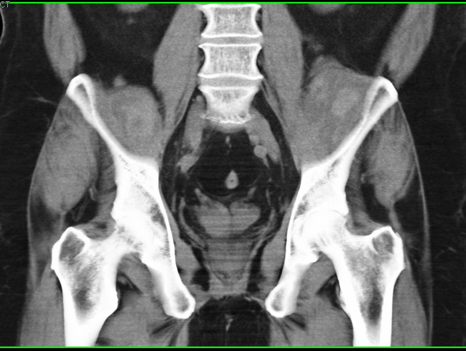 Bilateral Psoas Bleeds - CTisus CT Scan